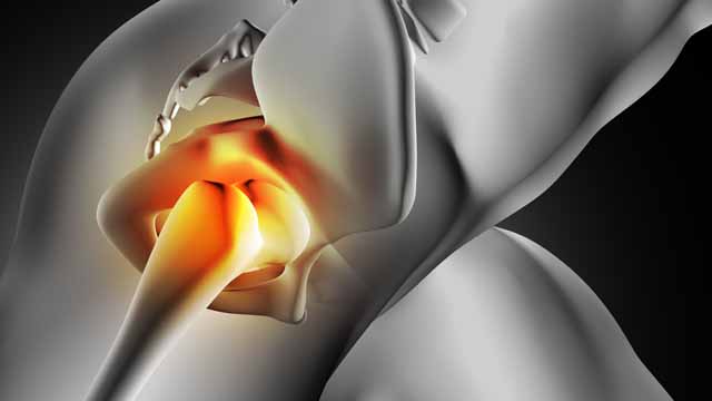 Tratamiento integral de la Artrosis de cadera sin cirugía